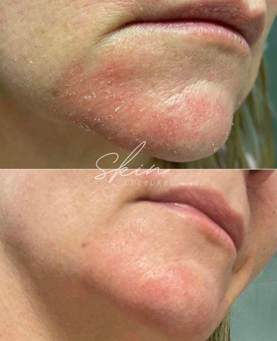 Before and After photo of a person's mouth area. The before photo shows dry, flaky chin area with redness caused by sensitivity and inflammation. The after photo shows a clearer complexion with reduced redness. 