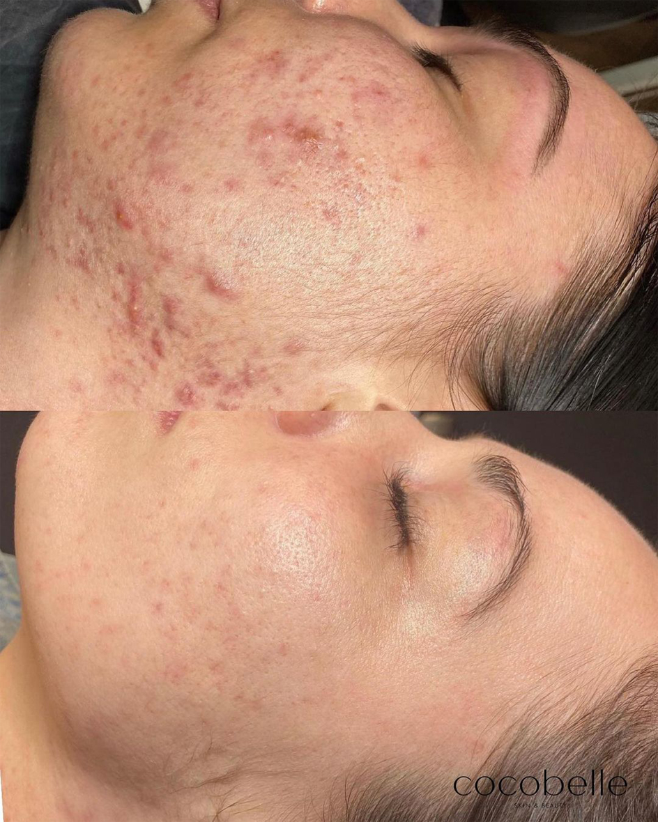 Before and After of a damaged skin barrier after treatment with O Cosmedics. In the before photo, the person had breakouts and acne, and the after photo presented a clearer complexion.